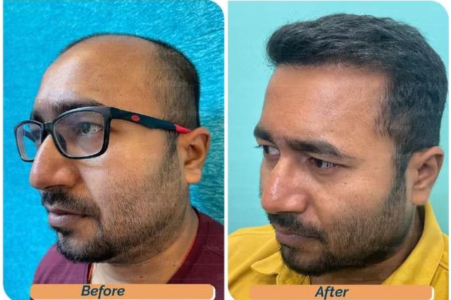 Hair transplant before and after in Delhi – 32-year-old male, Norwood IV, 3,320 grafts with Bio-FUE, result at 9 months (photo 3)