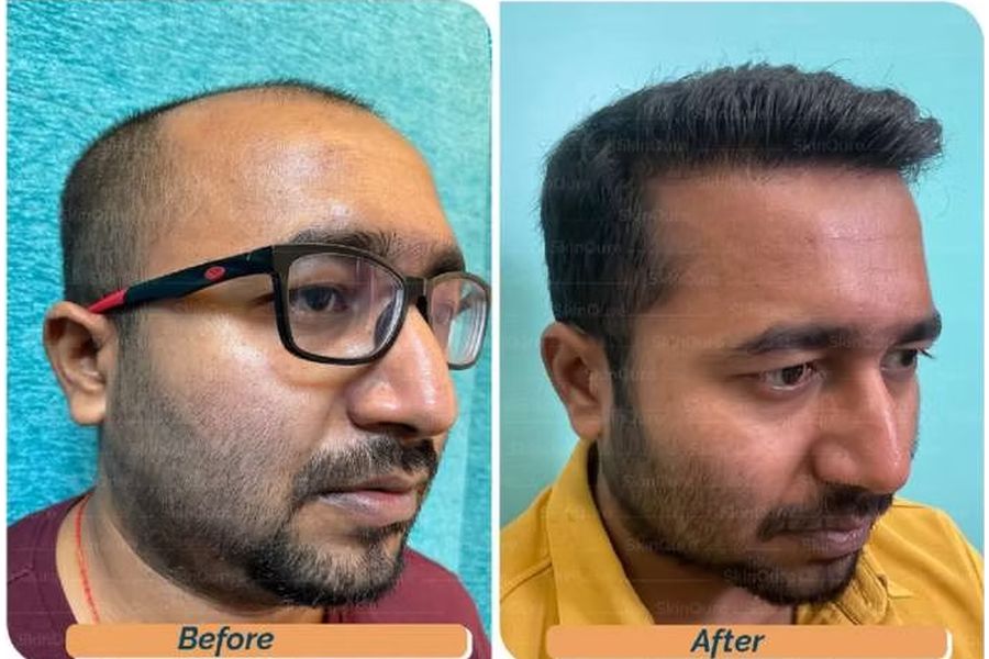 Hair transplant before and after in Delhi – 32-year-old male, Norwood IV, 3,320 grafts with Bio-FUE, result at 9 months (photo 4)