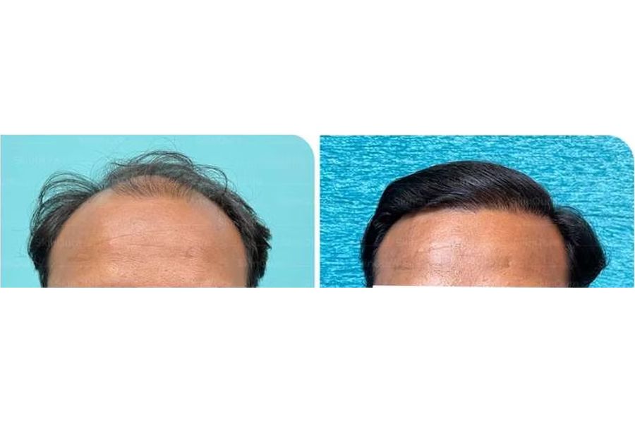 Hair transplant before and after in Delhi – 32-year-old male, Norwood IV, 3,500 grafts with EnRiched-FUE, result at 8 months (photo 1)