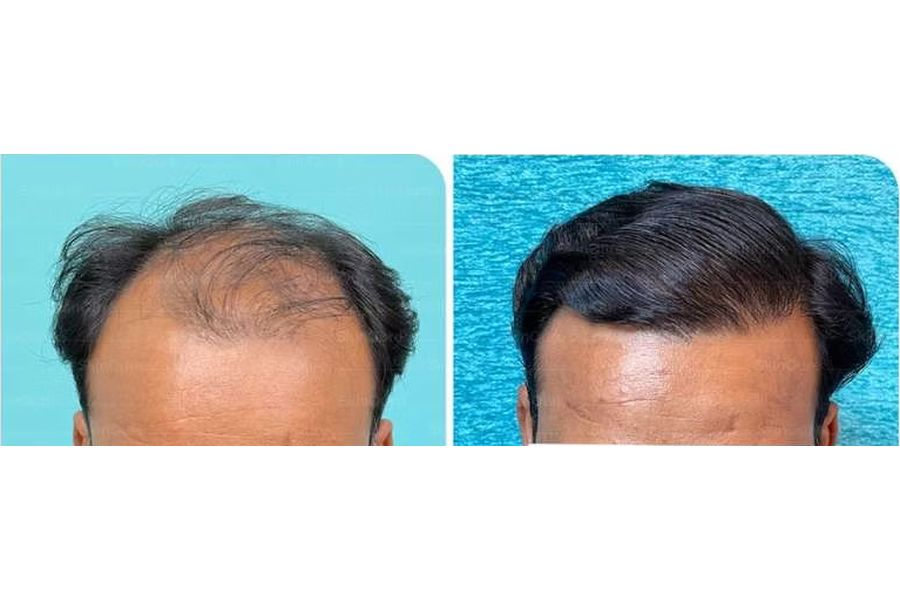 Hair transplant before and after in Delhi – 32-year-old male, Norwood IV, 3,500 grafts with EnRiched-FUE, result at 8 months (photo 2)