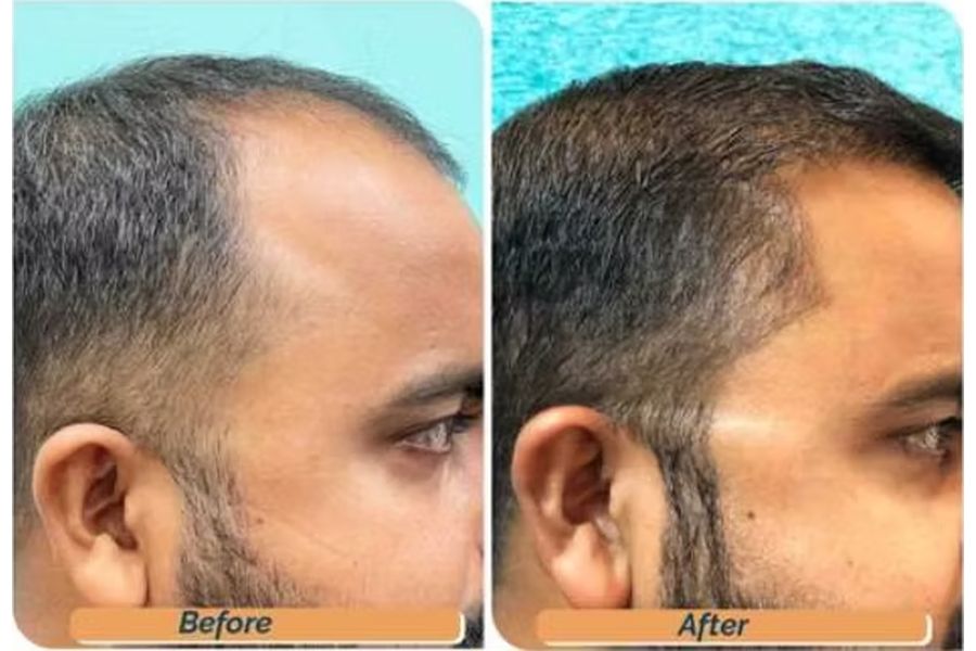 Hair transplant before and after in Delhi – 33-year-old male, Norwood II, 3,300 grafts with EnRiched-FUE, result at 8 months (photo 1)