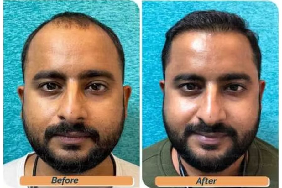Hair transplant before and after in Delhi – 33-year-old male, Norwood II, 3,300 grafts with EnRiched-FUE, result at 8 months (photo 2)