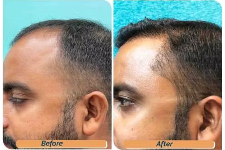 Hair transplant before and after in Delhi – 33-year-old male, Norwood II, 3,300 grafts with EnRiched-FUE, result at 8 months (photo 3)
