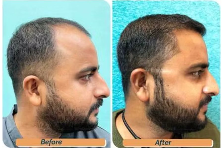 Hair transplant before and after in Delhi – 33-year-old male, Norwood II, 3,300 grafts with EnRiched-FUE, result at 8 months (photo 4)
