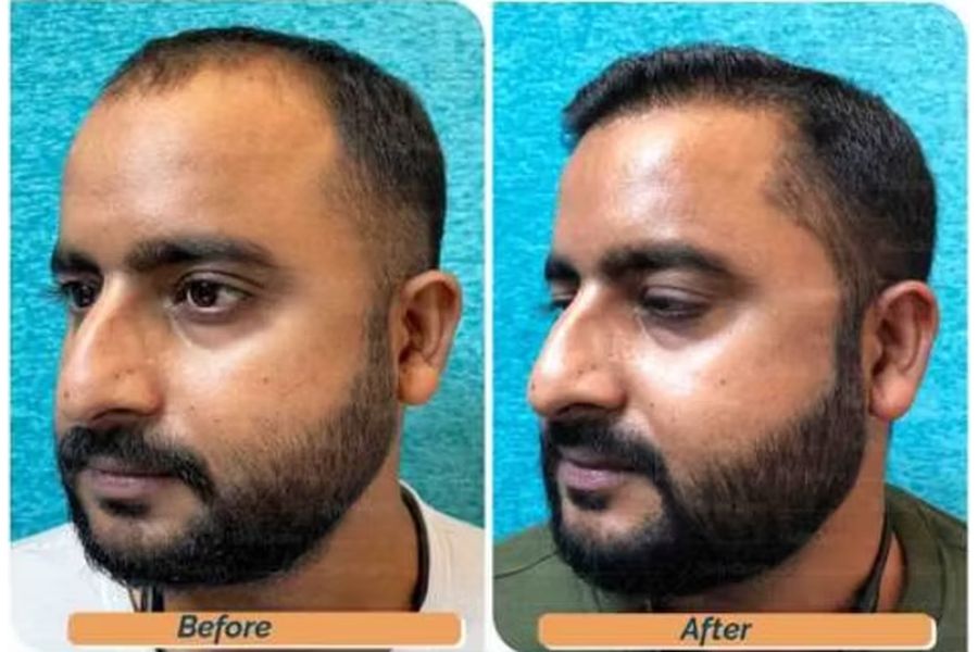Hair transplant before and after in Delhi – 33-year-old male, Norwood II, 3,300 grafts with EnRiched-FUE, result at 8 months (photo 5)