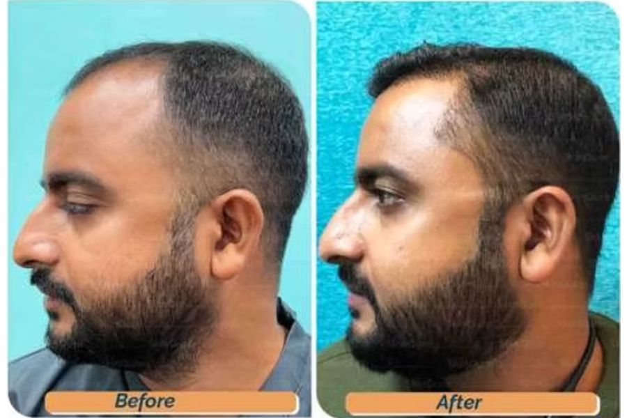 Hair transplant before and after in Delhi – 33-year-old male, Norwood II, 3,300 grafts with EnRiched-FUE, result at 8 months (photo 6)