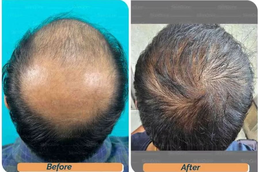 Hair transplant before and after in Delhi – 33-year-old male, Norwood VII, 5,500 grafts with EnRiched-FUE, result at 10 months (photo 1)