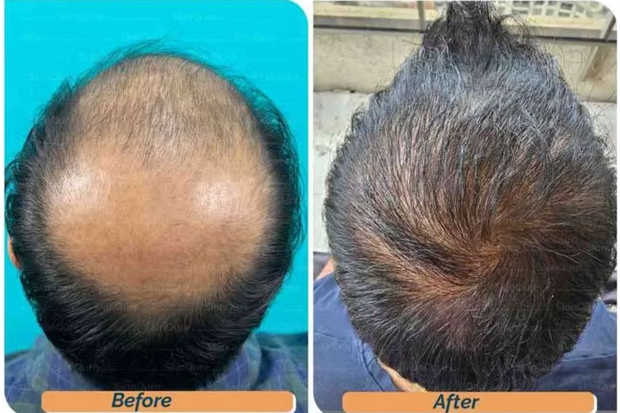Hair transplant before and after in Delhi – 33-year-old male, Norwood VII, 5,500 grafts with EnRiched-FUE, result at 10 months (photo 2)
