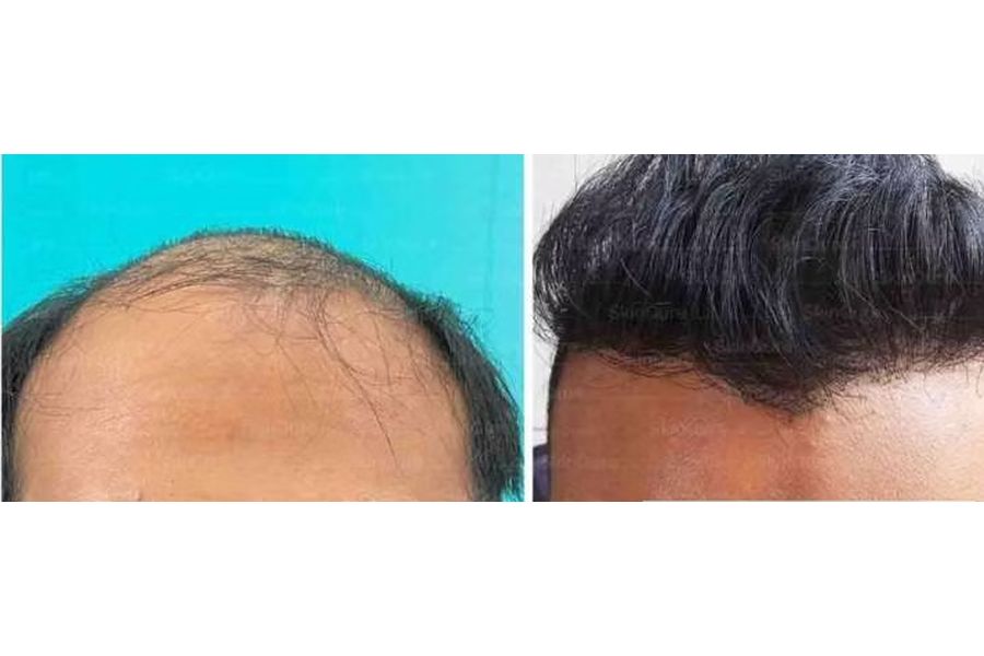 Hair transplant before and after in Delhi – 33-year-old male, Norwood VII, 5,500 grafts with EnRiched-FUE, result at 10 months (photo 3)