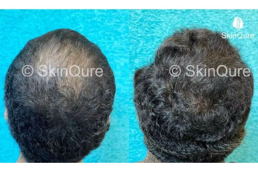 Hair transplant before and after in Delhi – 34-year-old male, Norwood IVa, 3,500 grafts with EnRiched-FUE, result at 8 months (photo 1)