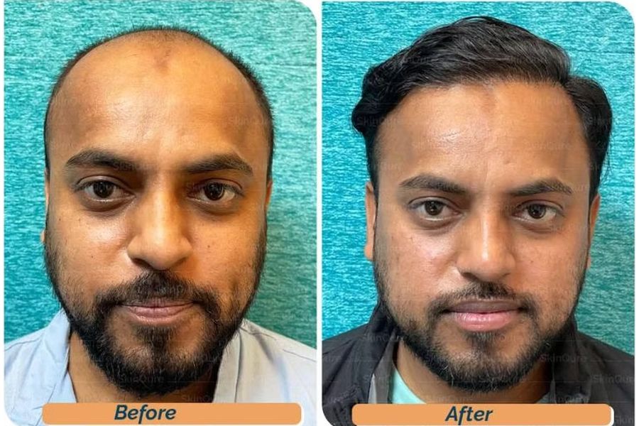 Hair transplant before and after in Delhi – 34-year-old male, Norwood V, 4,000 grafts with EnRiched-FUE, result at 8 months (photo 1)
