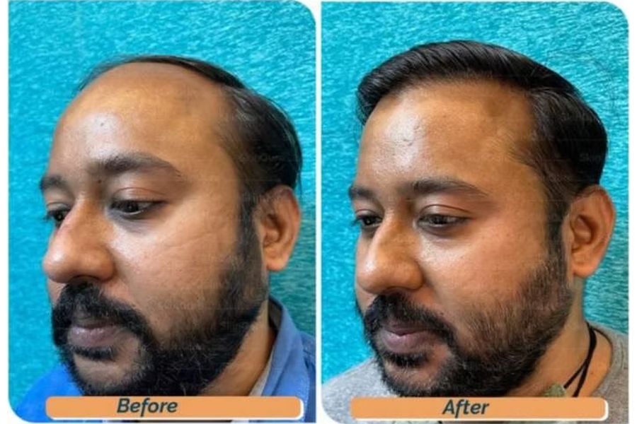 Hair transplant before and after in Delhi – 34-year-old male, Norwood V, 4,200 grafts with EnRiched-FUE, result at 10 months (photo 1)