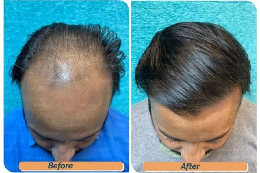 Hair transplant before and after in Delhi – 34-year-old male, Norwood V, 4,200 grafts with EnRiched-FUE, result at 10 months (photo 2)