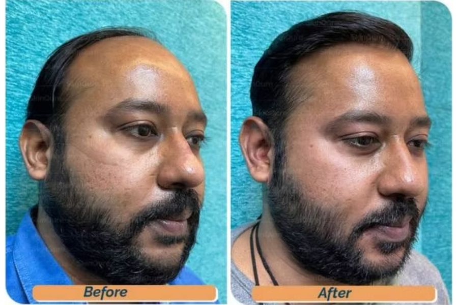 Hair transplant before and after in Delhi – 34-year-old male, Norwood V, 4,200 grafts with EnRiched-FUE, result at 10 months (photo 3)