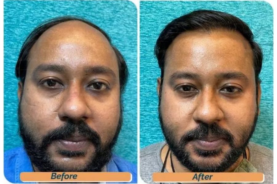 Hair transplant before and after in Delhi – 34-year-old male, Norwood V, 4,200 grafts with EnRiched-FUE, result at 10 months (photo 4)
