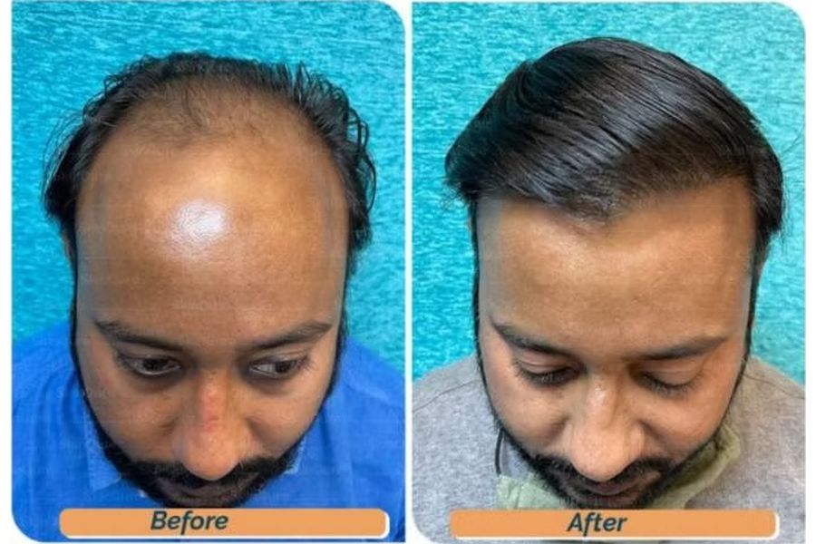 Hair transplant before and after in Delhi – 34-year-old male, Norwood V, 4,200 grafts with EnRiched-FUE, result at 10 months (photo 5)
