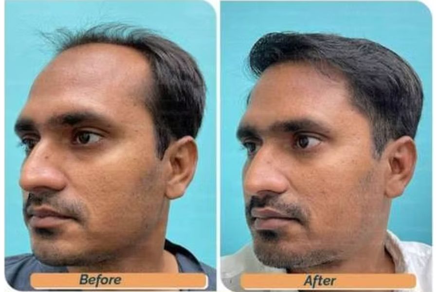 Hair transplant before and after in Delhi – 35-year-old male, Norwood IV, 3,200 grafts with EnRiched-FUE, result at 8 months (photo 1)