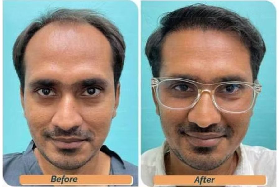 Hair transplant before and after in Delhi – 35-year-old male, Norwood IV, 3,200 grafts with EnRiched-FUE, result at 8 months (photo 2)