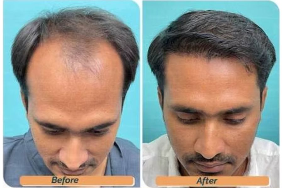 Hair transplant before and after in Delhi – 35-year-old male, Norwood IV, 3,200 grafts with EnRiched-FUE, result at 8 months (photo 3)