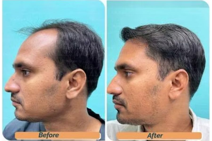 Hair transplant before and after in Delhi – 35-year-old male, Norwood IV, 3,200 grafts with EnRiched-FUE, result at 8 months (photo 4)