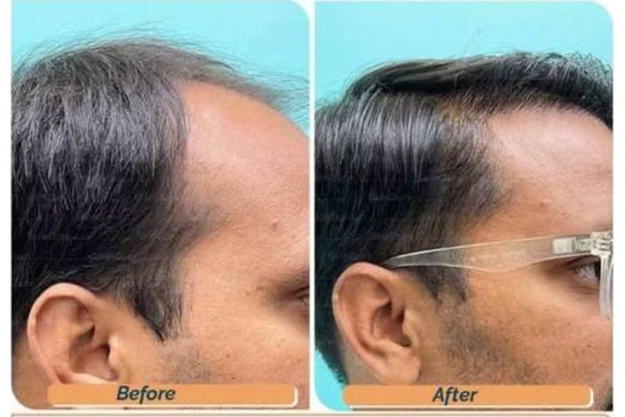 Hair transplant before and after in Delhi – 35-year-old male, Norwood IV, 3,200 grafts with EnRiched-FUE, result at 8 months (photo 5)