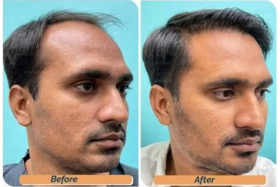 Hair transplant before and after in Delhi – 35-year-old male, Norwood IV, 3,200 grafts with EnRiched-FUE, result at 8 months (photo 6)