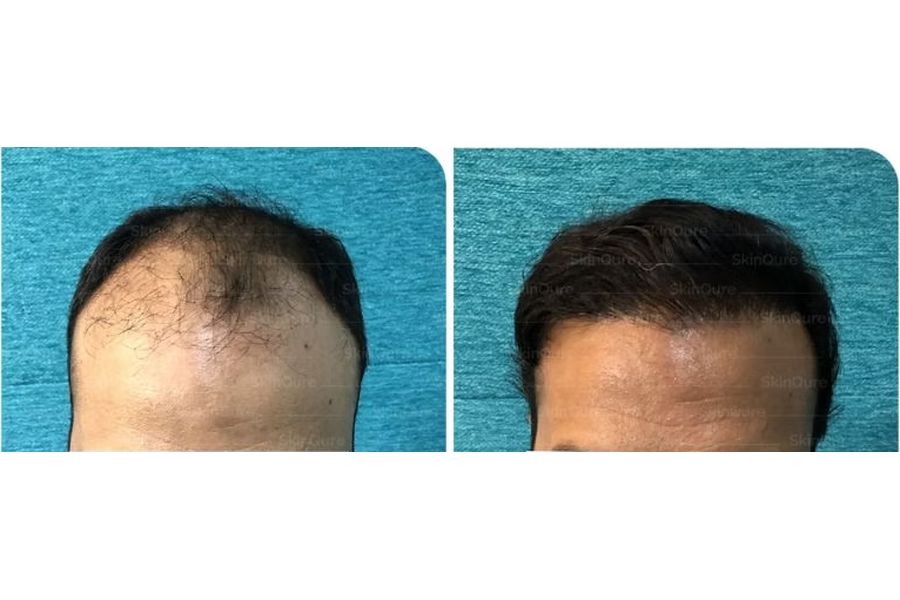 Hair transplant before and after in Delhi – 36-year-old male, Corrective Hair Transplant, 3,350 grafts with EnRiched-FUE, result at 10 months (photo 1)
