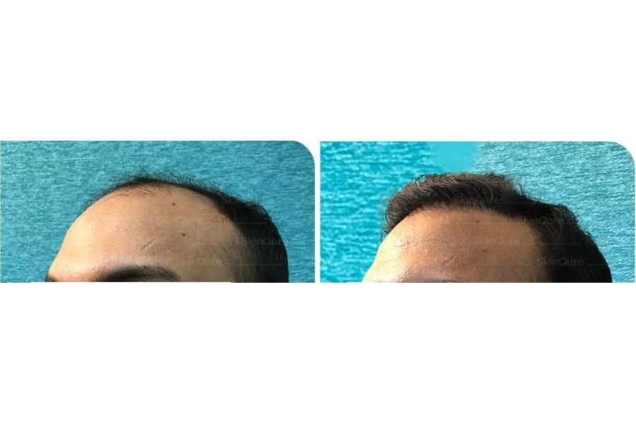 Hair transplant before and after in Delhi – 36-year-old male, Corrective Hair Transplant, 3,350 grafts with EnRiched-FUE, result at 10 months (photo 2)