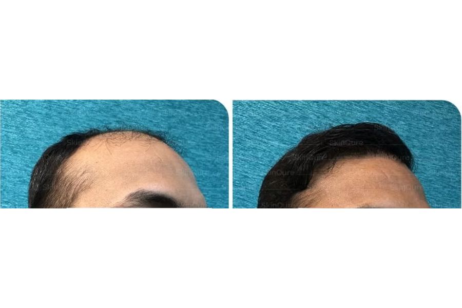 Hair transplant before and after in Delhi – 36-year-old male, Corrective Hair Transplant, 3,350 grafts with EnRiched-FUE, result at 10 months (photo 3)