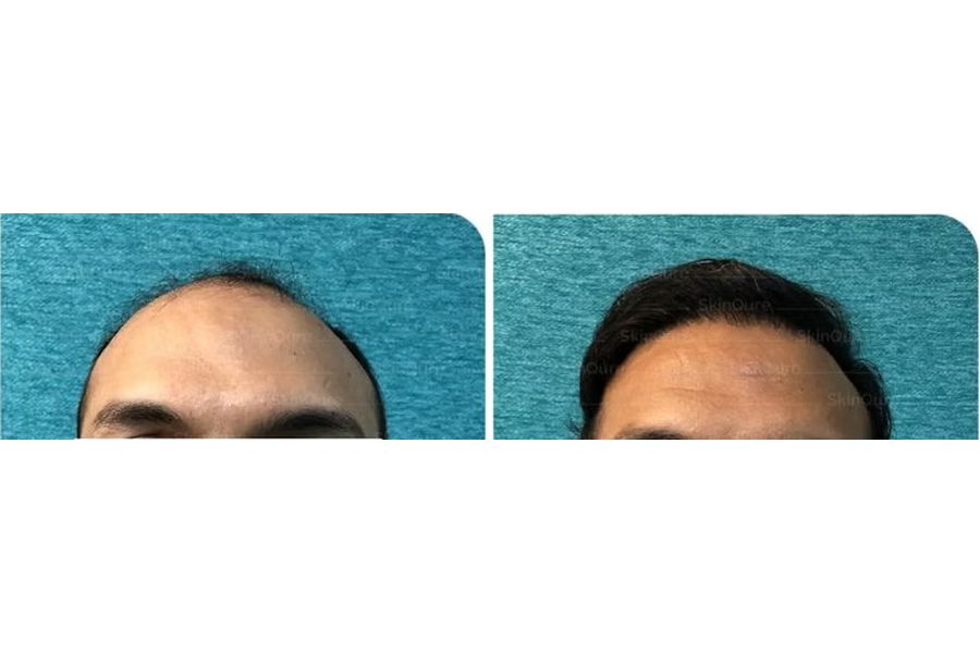 Hair transplant before and after in Delhi – 36-year-old male, Corrective Hair Transplant, 3,350 grafts with EnRiched-FUE, result at 10 months (photo 4)