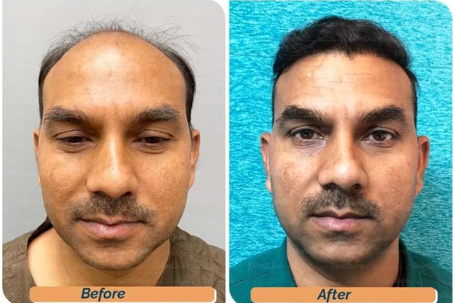 Hair transplant before and after in Delhi – 38-year-old male, AGA Grade VII, 3,215 grafts with EnRiched-FUE, result at 8 months (photo 1)