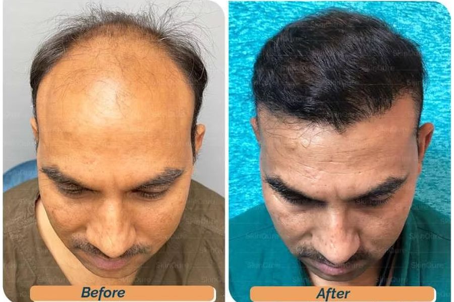 Hair transplant before and after in Delhi – 38-year-old male, AGA Grade VII, 3,215 grafts with EnRiched-FUE, result at 8 months (photo 2)