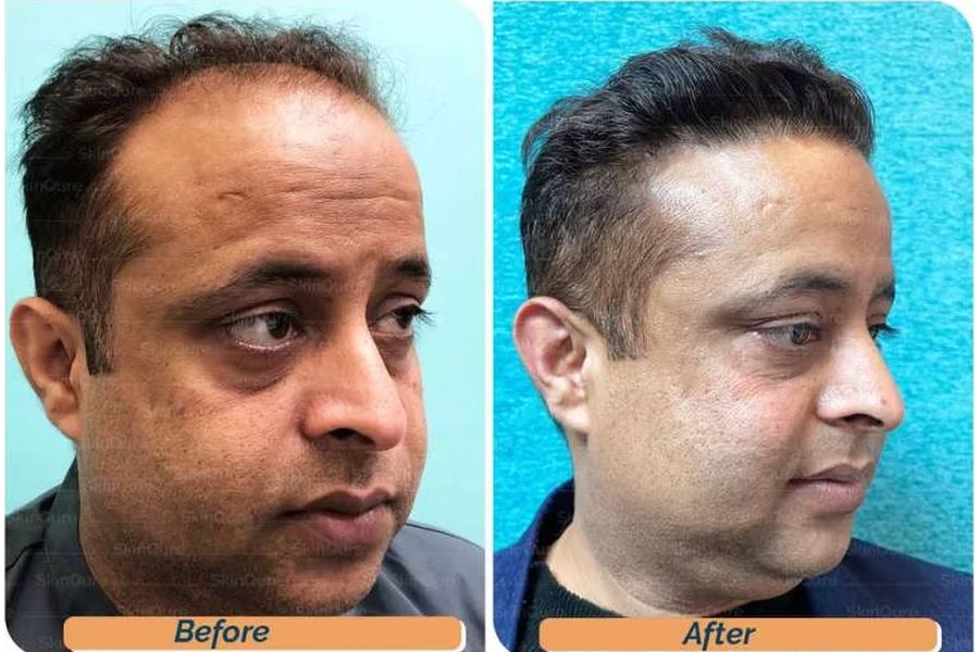 Hair transplant before and after in Delhi – 38-year-old male, Norwood V, 3,700 grafts with EnRiched-FUE, result at 7 months (photo 1)