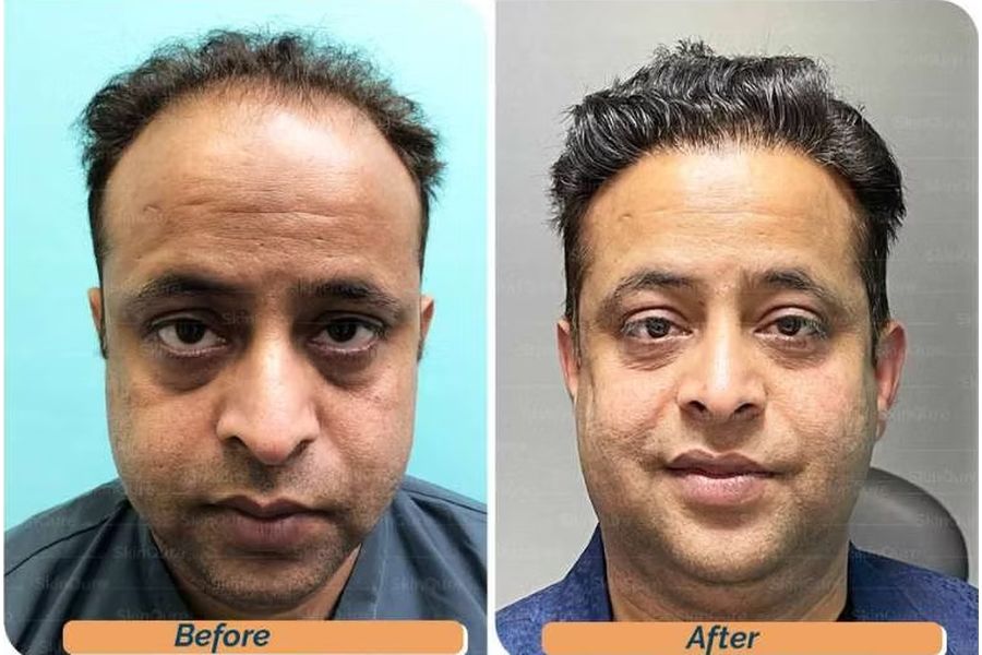 Hair transplant before and after in Delhi – 38-year-old male, Norwood V, 3,700 grafts with EnRiched-FUE, result at 7 months (photo 2)