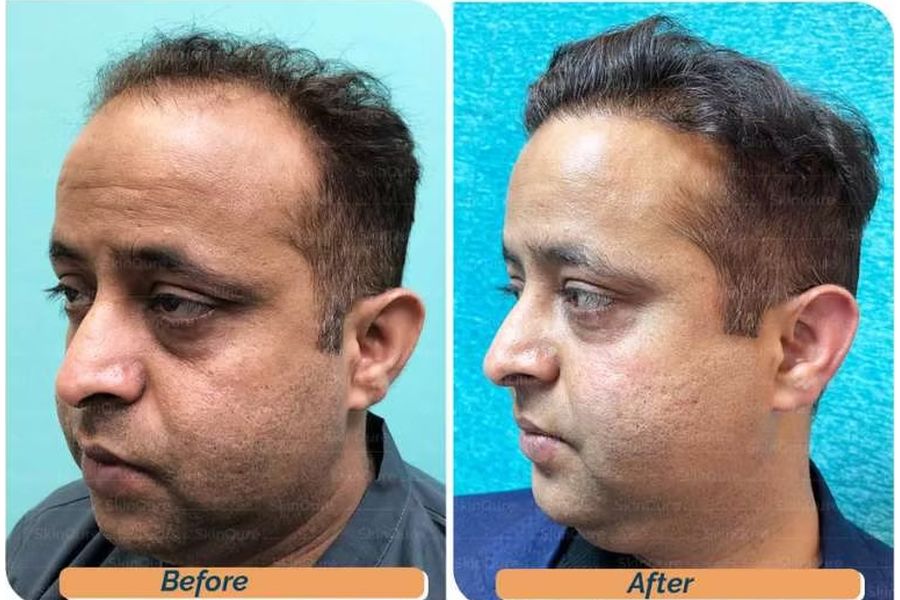 Hair transplant before and after in Delhi – 38-year-old male, Norwood V, 3,700 grafts with EnRiched-FUE, result at 7 months (photo 3)