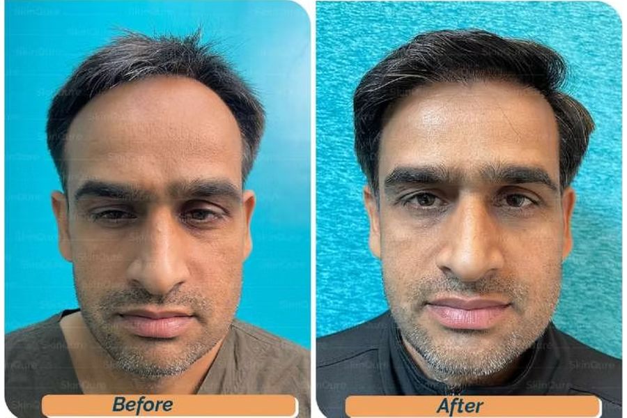 Hair transplant before and after in Delhi – 39-year-old male, Norwood III, 3,050 grafts with Bio-FUE, result at 11 months (photo 1)