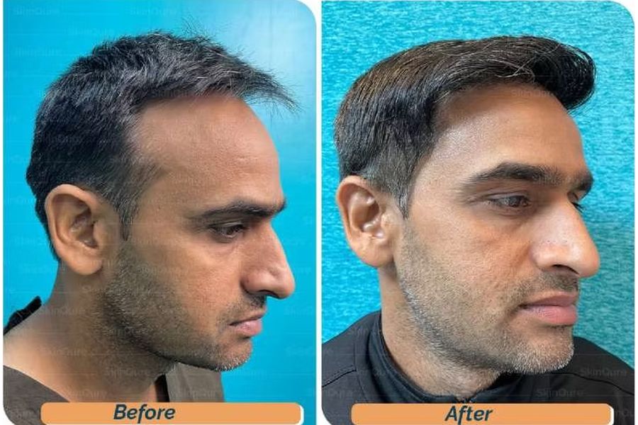 Hair transplant before and after in Delhi – 39-year-old male, Norwood III, 3,050 grafts with Bio-FUE, result at 11 months (photo 2)
