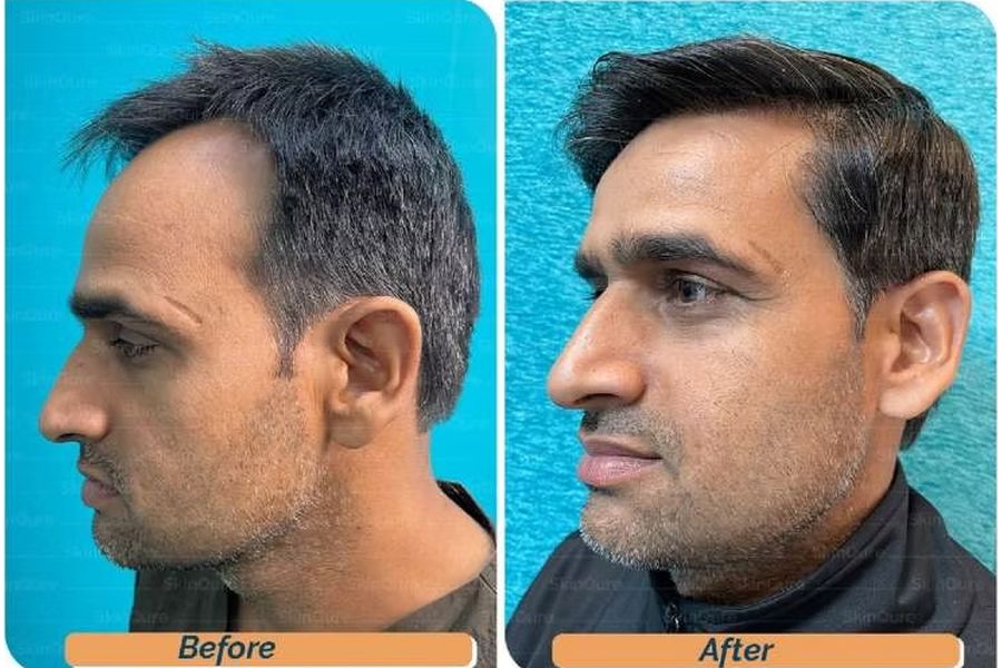 Hair transplant before and after in Delhi – 39-year-old male, Norwood III, 3,050 grafts with Bio-FUE, result at 11 months (photo 3)