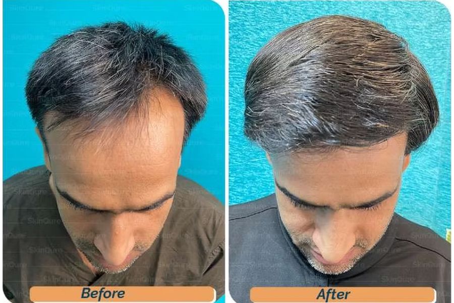 Hair transplant before and after in Delhi – 39-year-old male, Norwood III, 3,050 grafts with Bio-FUE, result at 11 months (photo 4)
