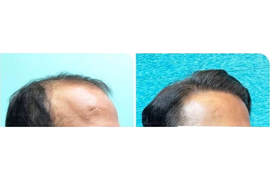 Hair transplant before and after in Delhi – 39-year-old male, Norwood VI, 5,200 grafts with EnRiched-FUE, result at 5 months (photo 1)