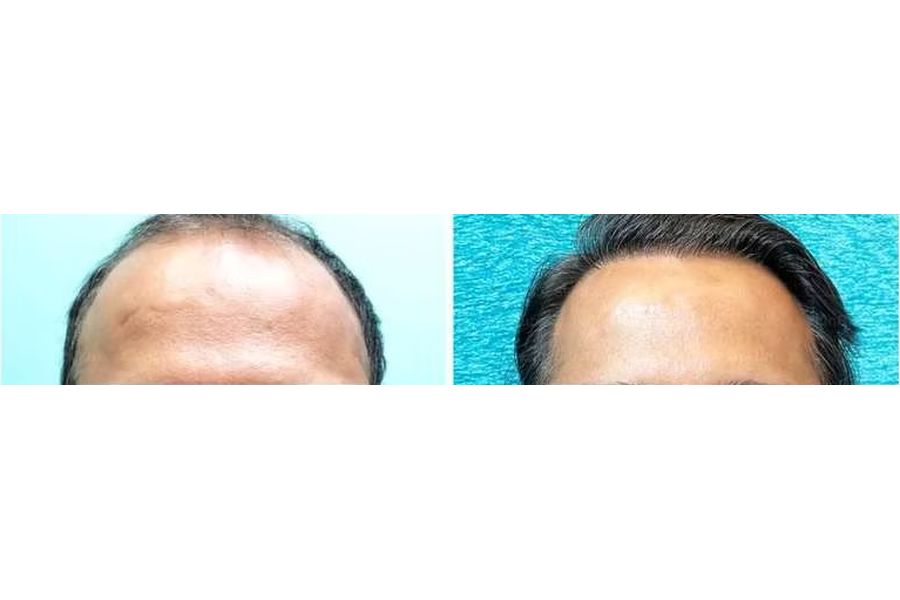 Hair transplant before and after in Delhi – 39-year-old male, Norwood VI, 5,200 grafts with EnRiched-FUE, result at 5 months (photo 2)