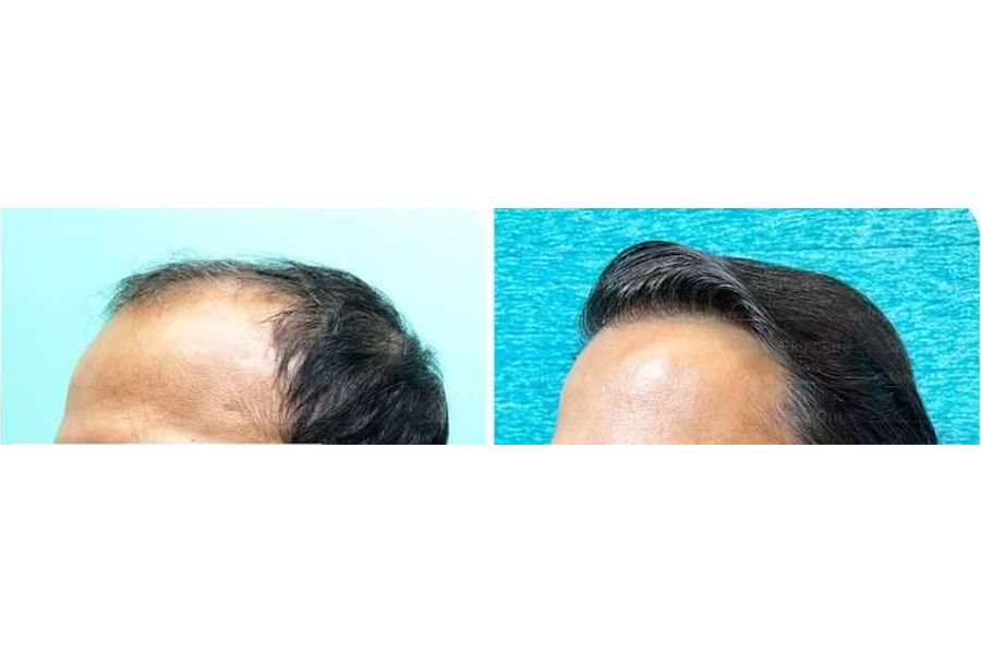Hair transplant before and after in Delhi – 39-year-old male, Norwood VI, 5,200 grafts with EnRiched-FUE, result at 5 months (photo 3)