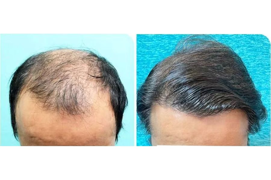 Hair transplant before and after in Delhi – 39-year-old male, Norwood VI, 5,200 grafts with EnRiched-FUE, result at 5 months (photo 4)