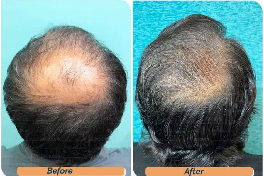 Hair transplant before and after in Delhi – 39-year-old male, Norwood VI, 5,200 grafts with EnRiched-FUE, result at 5 months (photo 5)