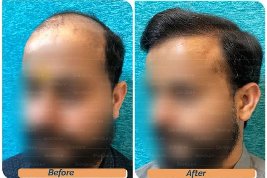 Hair transplant before and after in Delhi – 40-year-old male, Norwood VII, 5,600 grafts with EnRiched-FUE, result at 10 months (photo 1)