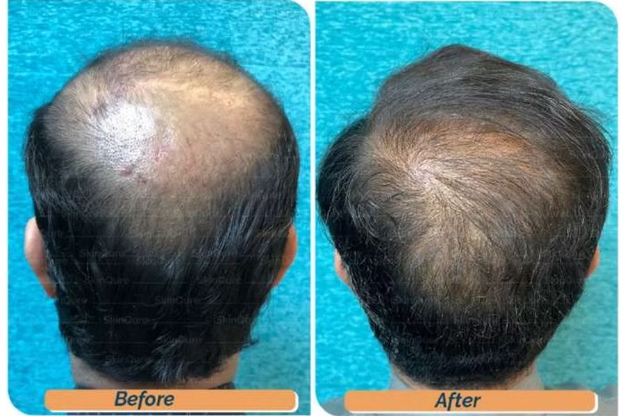 Hair transplant before and after in Delhi – 40-year-old male, Norwood VII, 5,600 grafts with EnRiched-FUE, result at 10 months (photo 2)