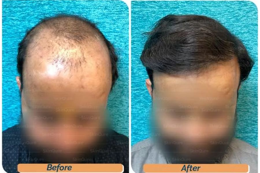 Hair transplant before and after in Delhi – 40-year-old male, Norwood VII, 5,600 grafts with EnRiched-FUE, result at 10 months (photo 3)