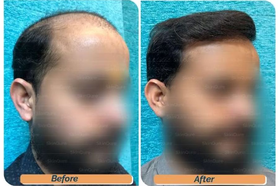 Hair transplant before and after in Delhi – 40-year-old male, Norwood VII, 5,600 grafts with EnRiched-FUE, result at 10 months (photo 4)