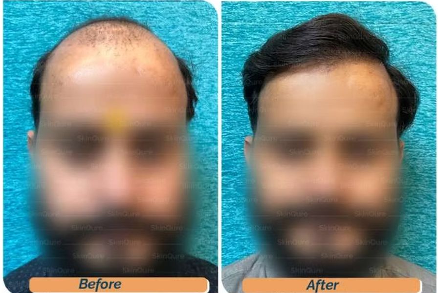 Hair transplant before and after in Delhi – 40-year-old male, Norwood VII, 5,600 grafts with EnRiched-FUE, result at 10 months (photo 5)