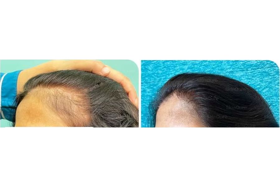 Hair transplant before and after in Delhi – 42-year-old female, Grade II, 2,200 grafts with EnRiched-FUE, result at 8 months (photo 1)
